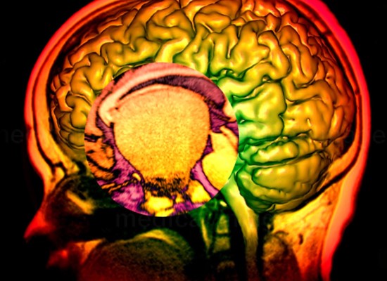 Post-graduate course Childhood Craniopharyngioma